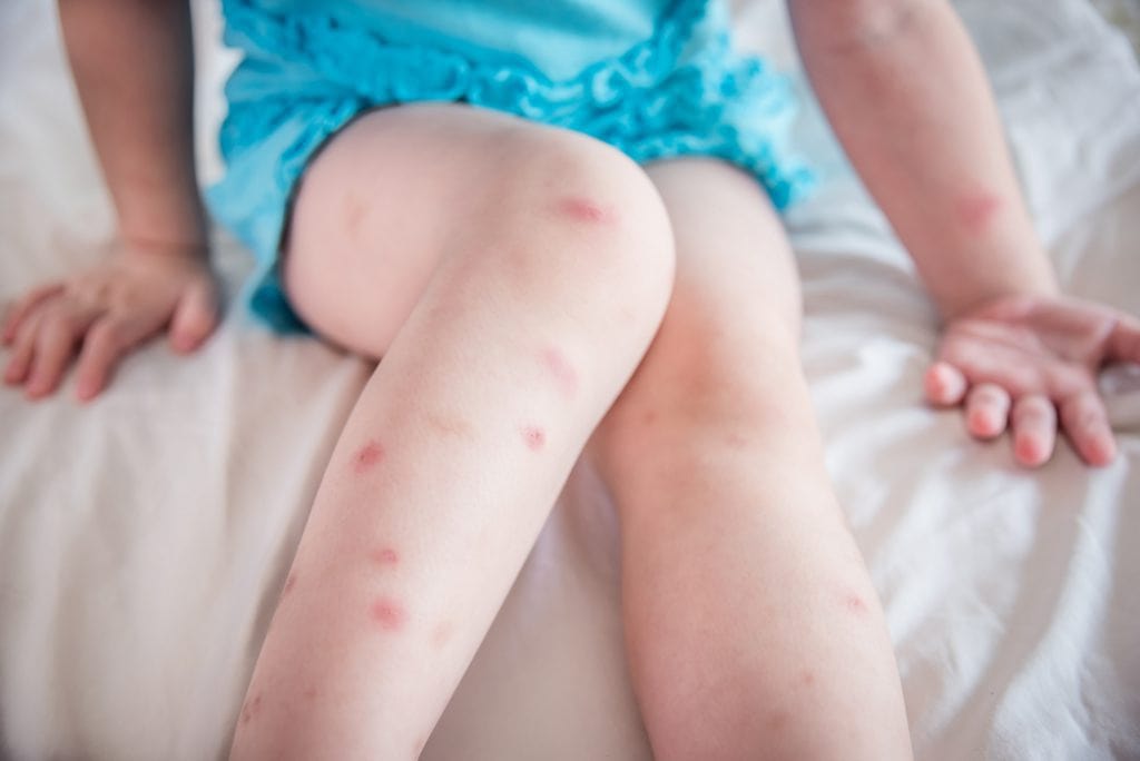 Démangeaisons causées par des piqûres de punaises de lit sur la peau